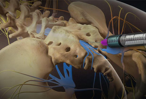 Caudal Epidural Steroid Injection for auto accident injury