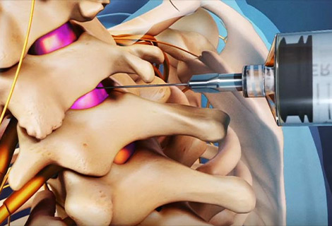 Cervical Epidural Steroid Injection for auto accident injury