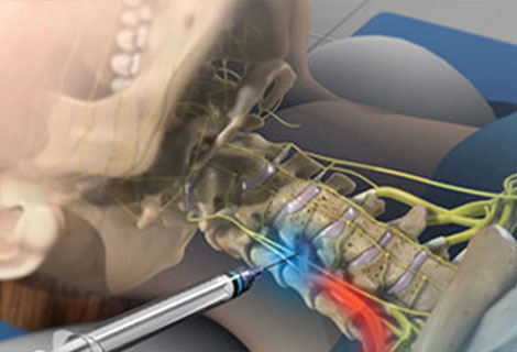 Cervical and Thoracic Epidural for auto accident injury