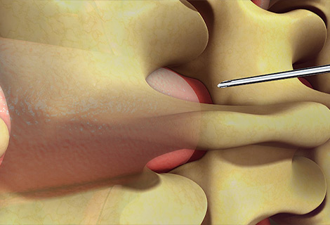 Epidural Steroid Injection for auto accident injury