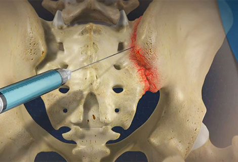 Sacroiliac Joint Injections for auto accident injury