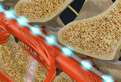 Spinal Cord Stimulator for auto accident injury